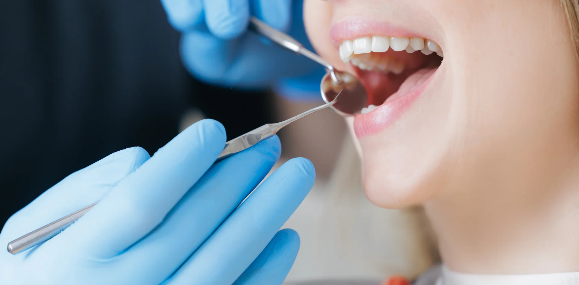 Tooth-colored fillings