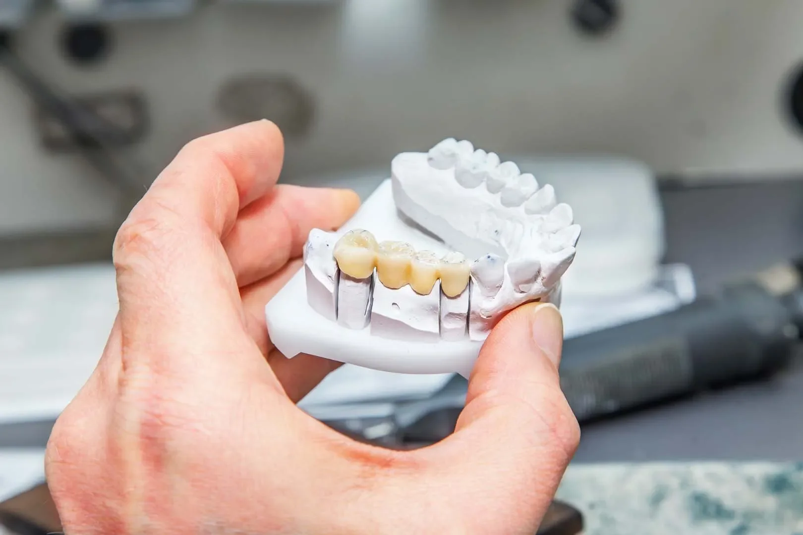 Dental bridge treatment at Berry Road Dental