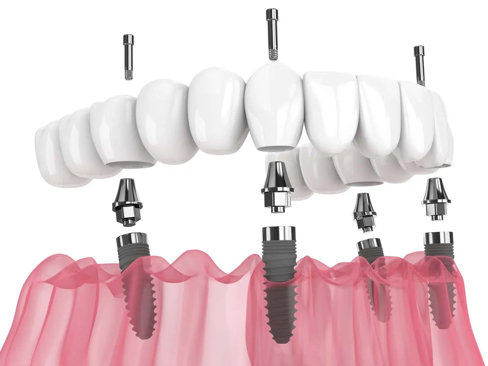 All-on-4 full-arch implants