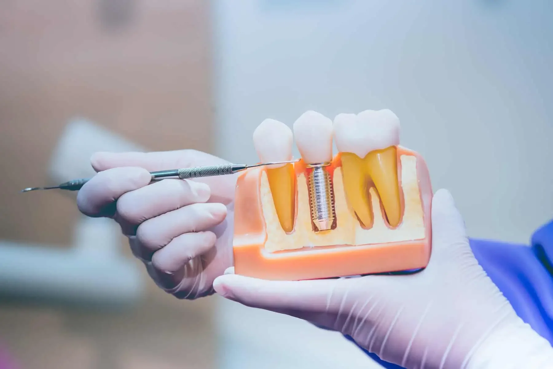 Dental implants and tooth replacement