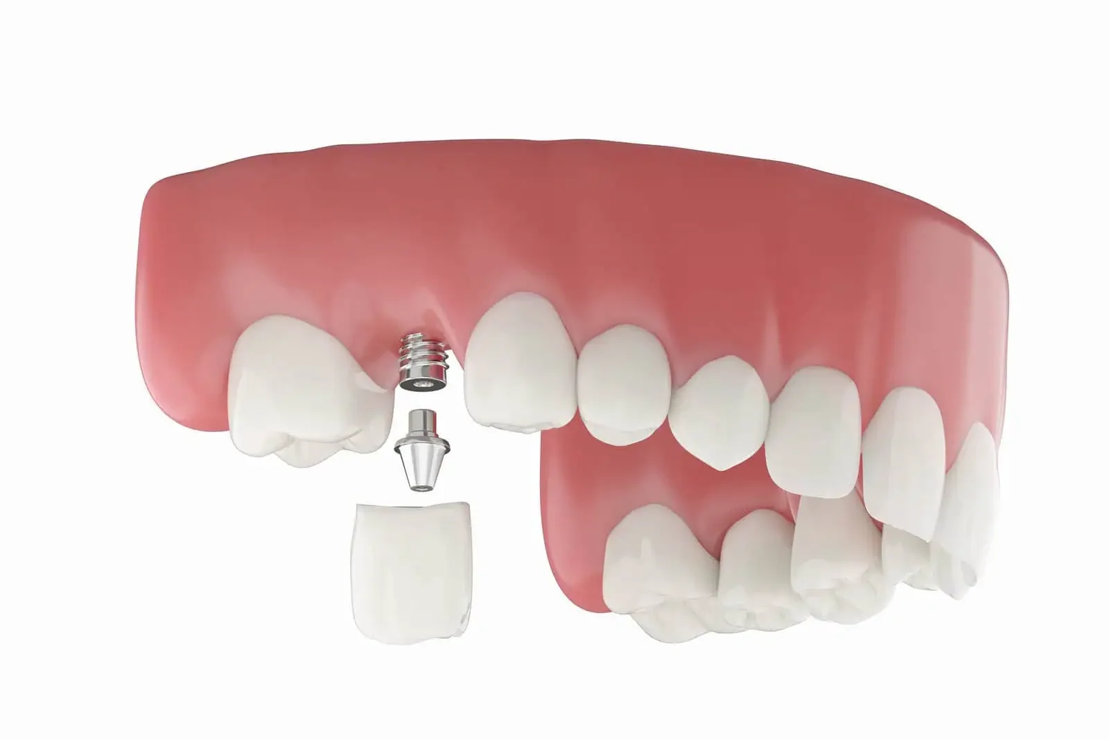 Single tooth implant