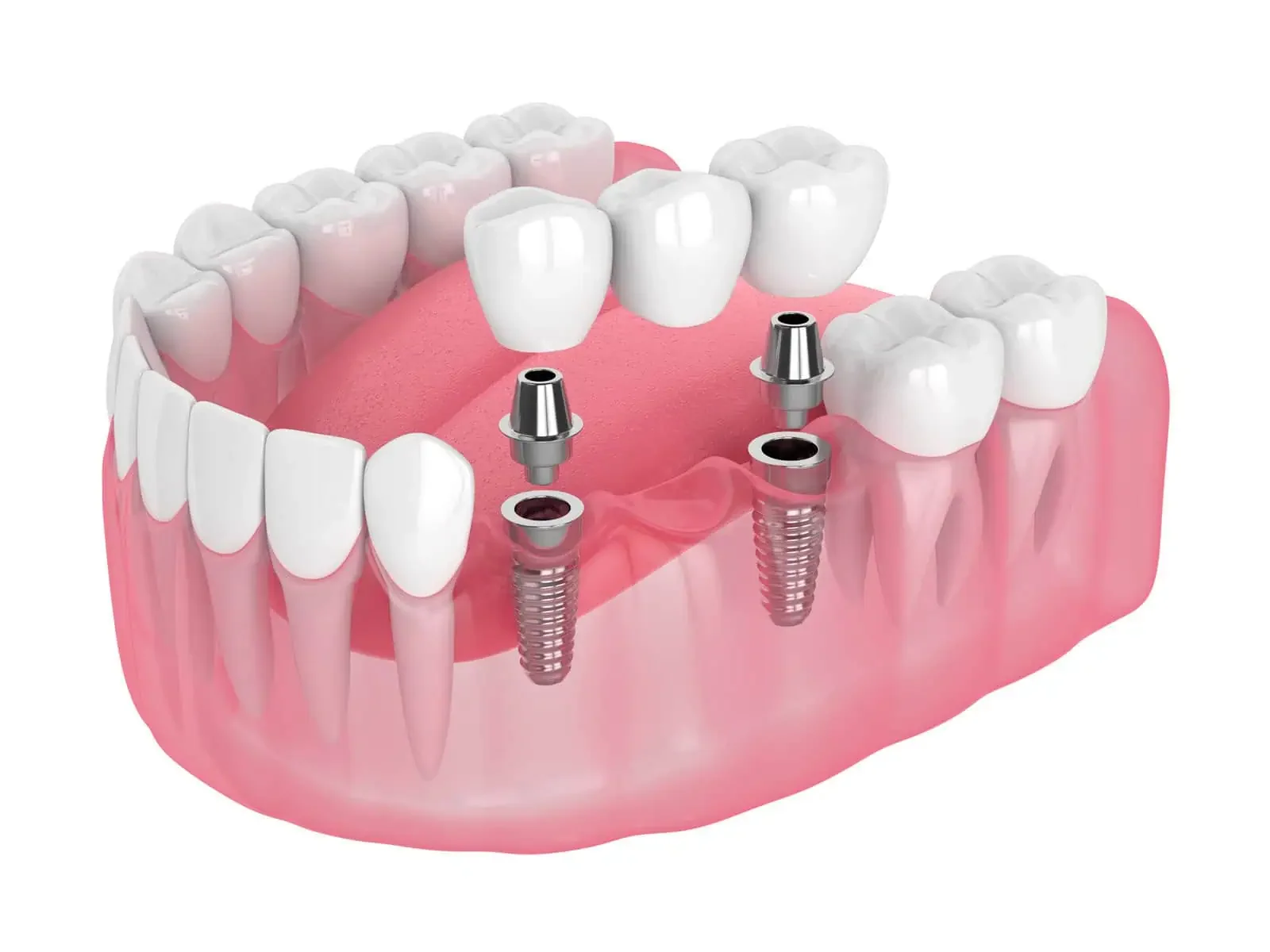 Implant-supported dentures